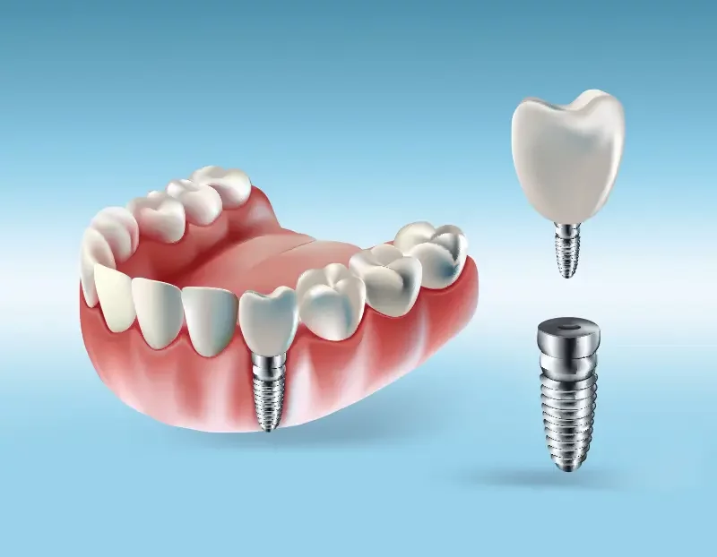 Implantat-Altbach